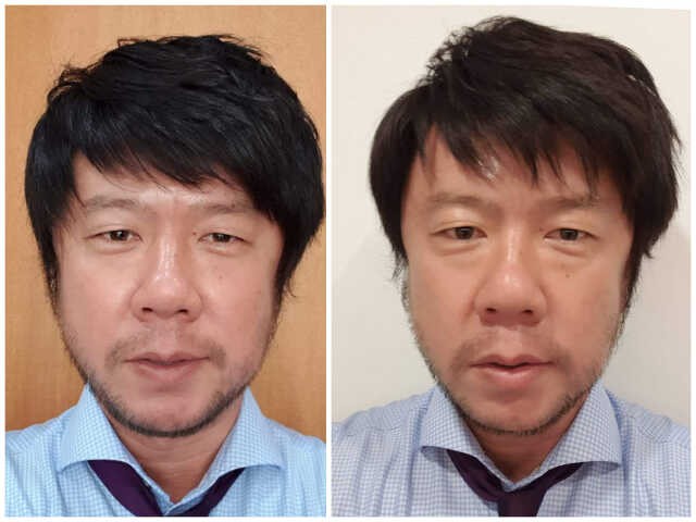 45歳の男が韓国・大邱で最新の顔美容を受けてみたら…… DANRO